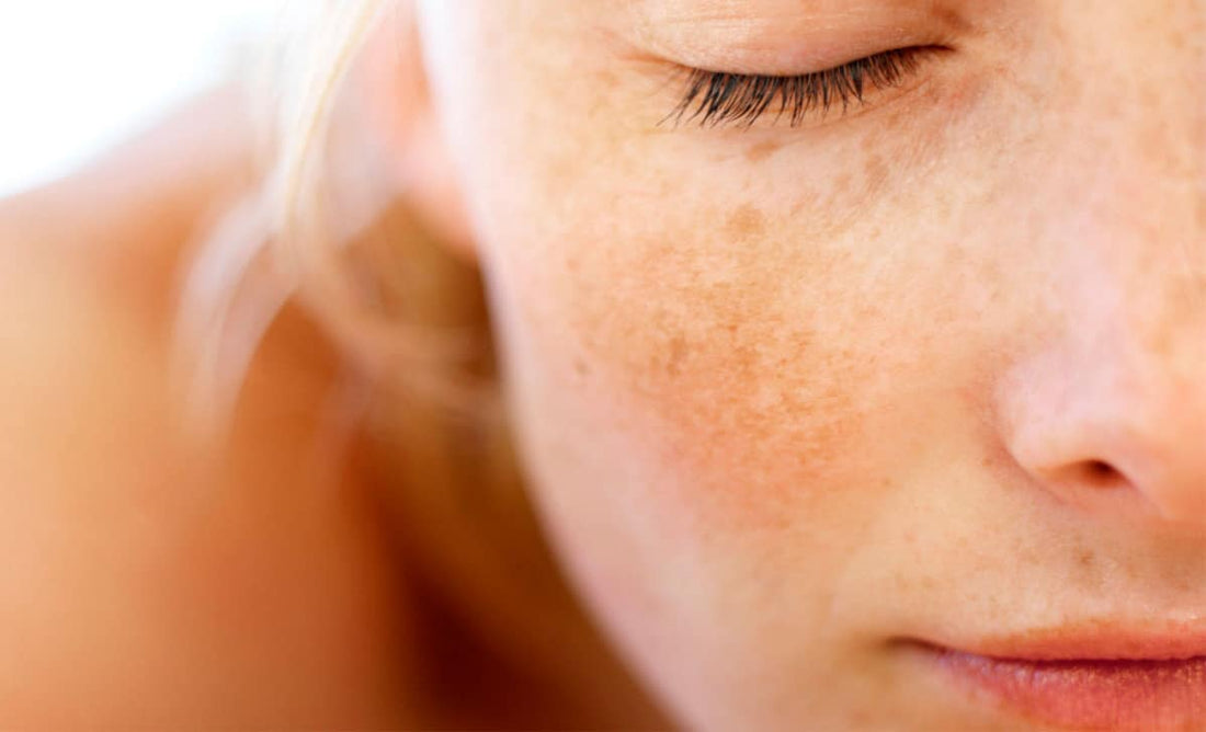 Macchie della pelle: come prevenirle e trattarle per una pelle radiosa e senza imperfezioni